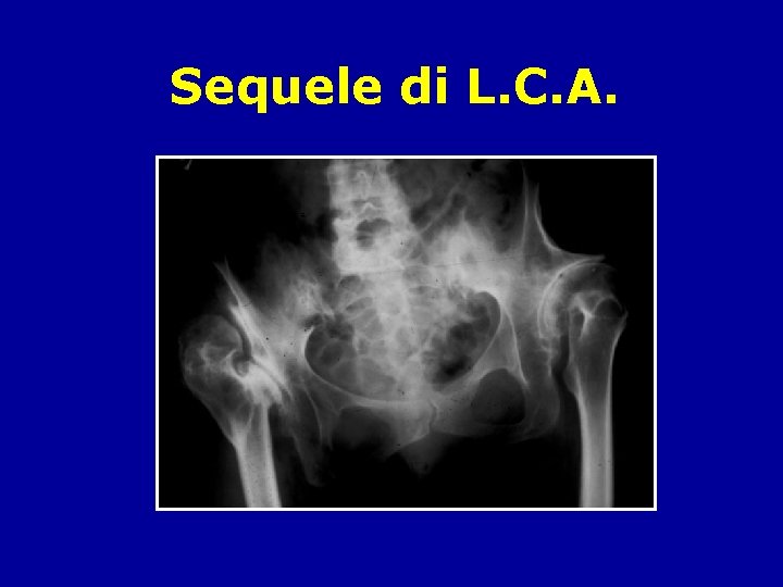 Sequele di L. C. A. 