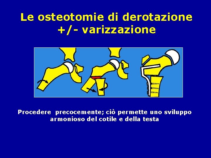 Le osteotomie di derotazione +/- varizzazione Procedere precocemente; ciò permette uno sviluppo armonioso del