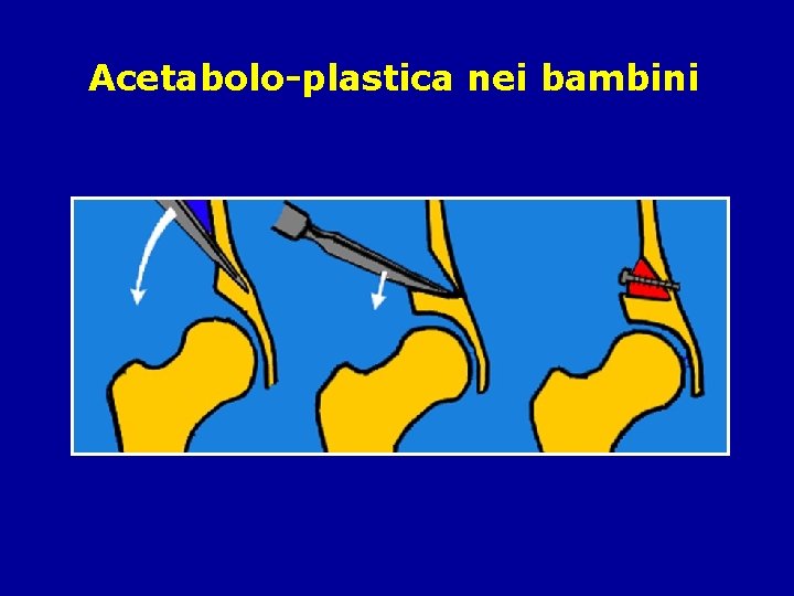 Acetabolo-plastica nei bambini 