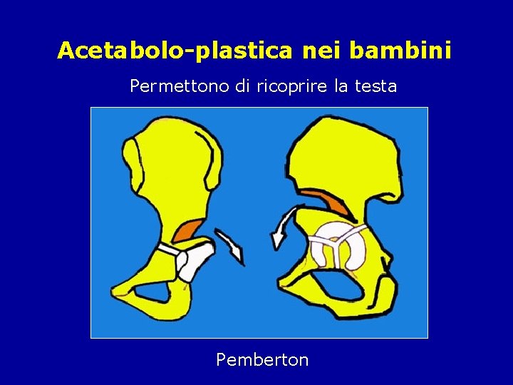 Acetabolo-plastica nei bambini Permettono di ricoprire la testa Pemberton 