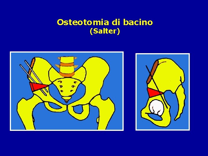 Osteotomia di bacino (Salter) 