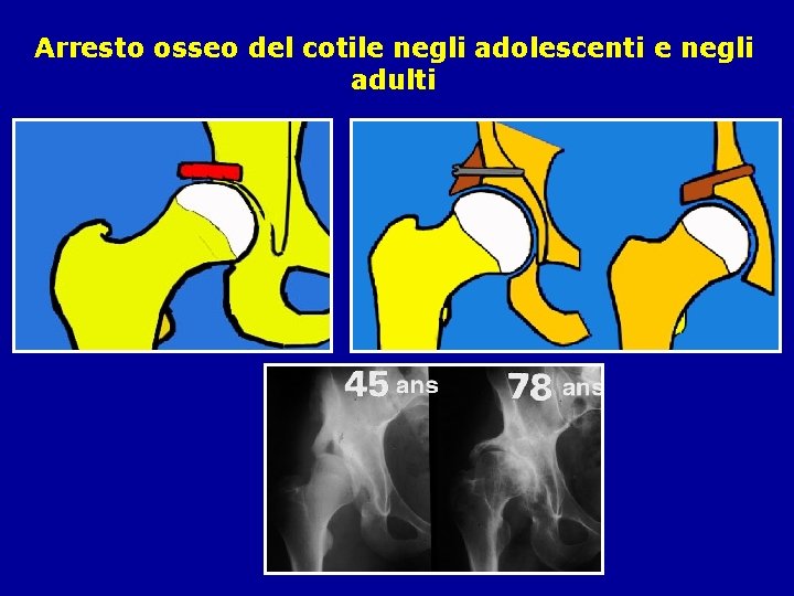 Arresto osseo del cotile negli adolescenti e negli adulti 