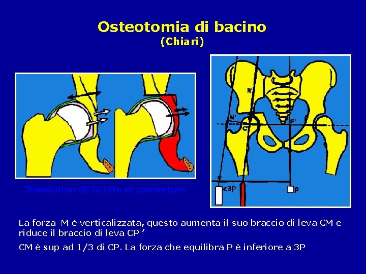 Osteotomia di bacino (Chiari) Translation de la tête et couverture La forza M è