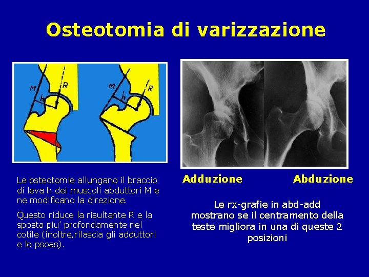 Osteotomia di varizzazione Le osteotomie allungano il braccio di leva h dei muscoli abduttori