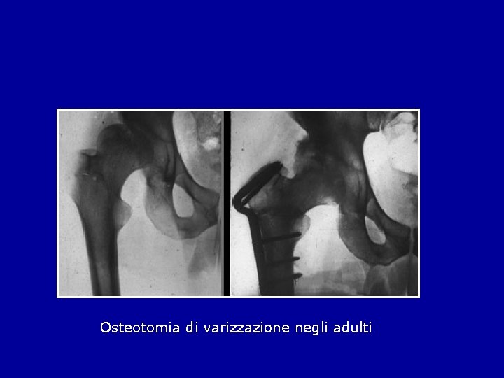 Osteotomia di varizzazione negli adulti 