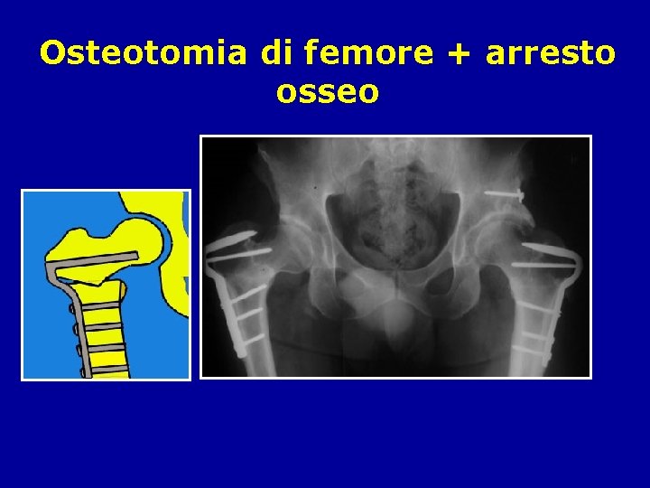 Osteotomia di femore + arresto osseo 
