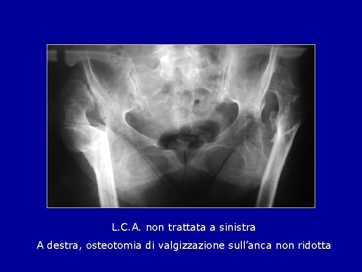 L. C. A. non trattata a sinistra A destra, osteotomia di valgizzazione sull’anca non