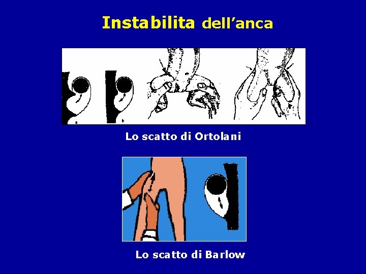 Instabilita dell’anca Lo scatto di Ortolani Lo scatto di Barlow 