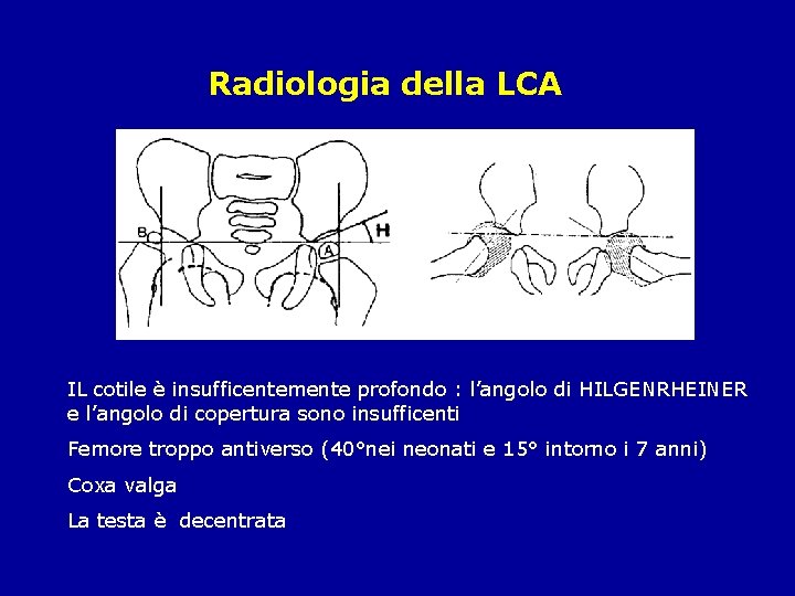 Radiologia della LCA IL cotile è insufficentemente profondo : l’angolo di HILGENRHEINER e l’angolo