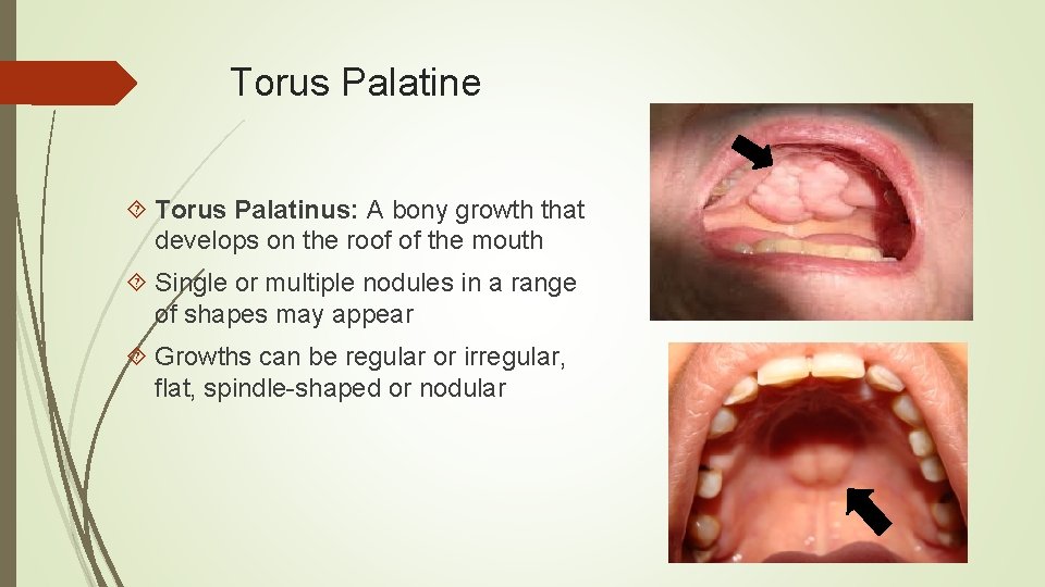 Torus Palatine Torus Palatinus: A bony growth that develops on the roof of the