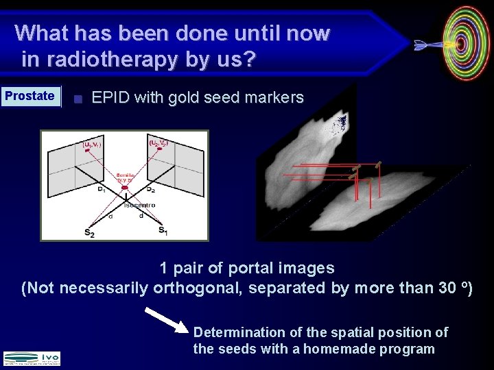 What has been done until now in radiotherapy by us? Prostate ■ EPID with