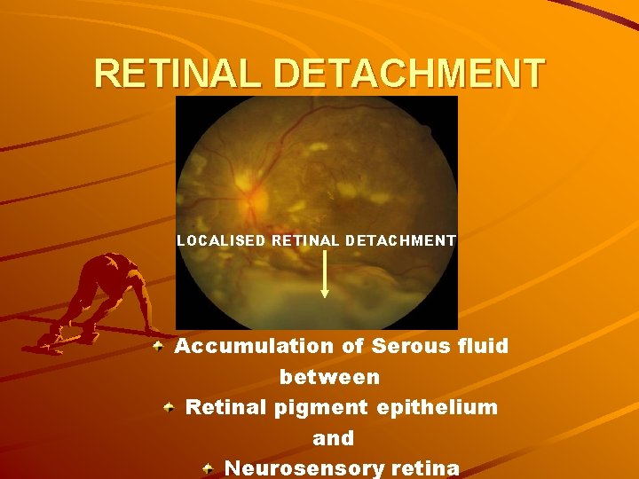 RETINAL DETACHMENT LOCALISED RETINAL DETACHMENT Accumulation of Serous fluid between Retinal pigment epithelium and