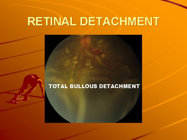RETINAL DETACHMENT TOTAL BULLOUS DETACHMENT 