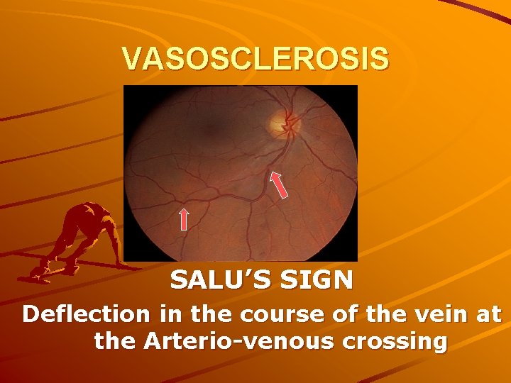 VASOSCLEROSIS SALU’S SIGN Deflection in the course of the vein at the Arterio-venous crossing