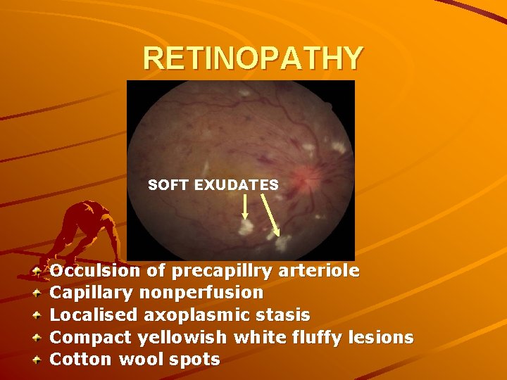 RETINOPATHY SOFT EXUDATES Occulsion of precapillry arteriole Capillary nonperfusion Localised axoplasmic stasis Compact yellowish