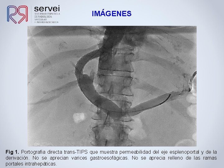 IMÁGENES Fig 1. Portografia directa trans-TIPS que muestra permeabilidad del eje esplenoportal y de