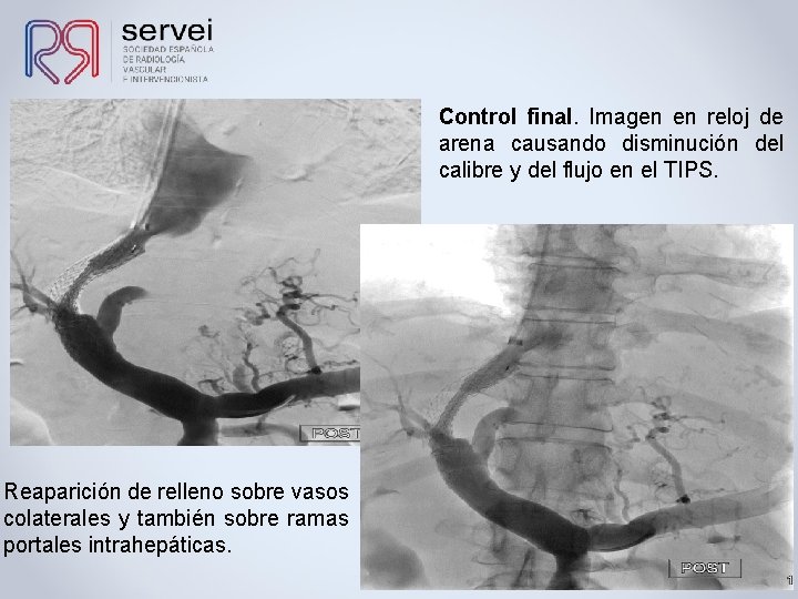 Control final. Imagen en reloj de arena causando disminución del calibre y del flujo