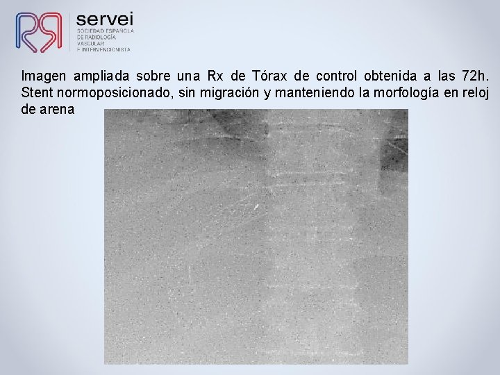 Imagen ampliada sobre una Rx de Tórax de control obtenida a las 72 h.