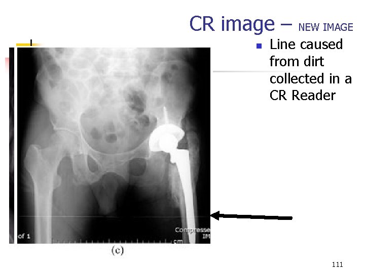 CR image – n NEW IMAGE Line caused from dirt collected in a CR