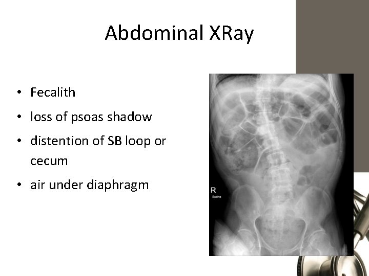 Abdominal XRay • Fecalith • loss of psoas shadow • distention of SB loop