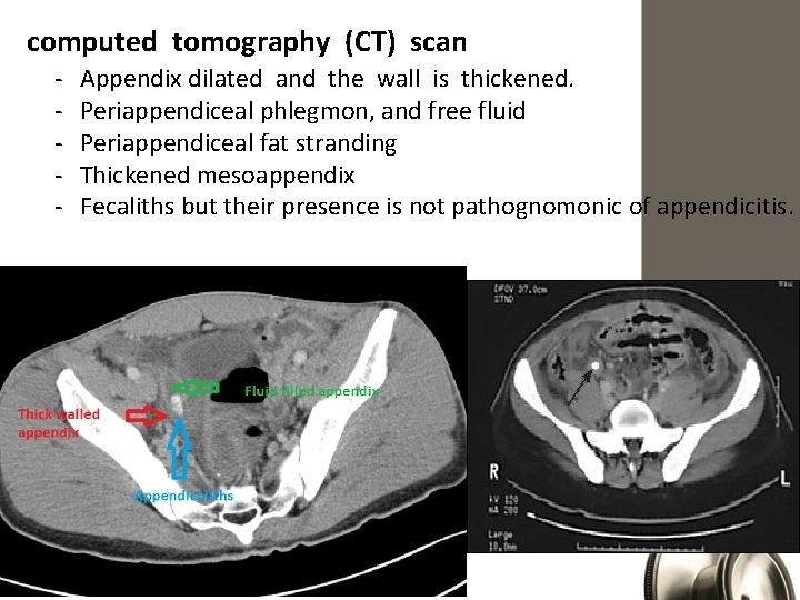 computed tomography (CT) scan - Appendix dilated and the wall is thickened. Periappendiceal phlegmon,