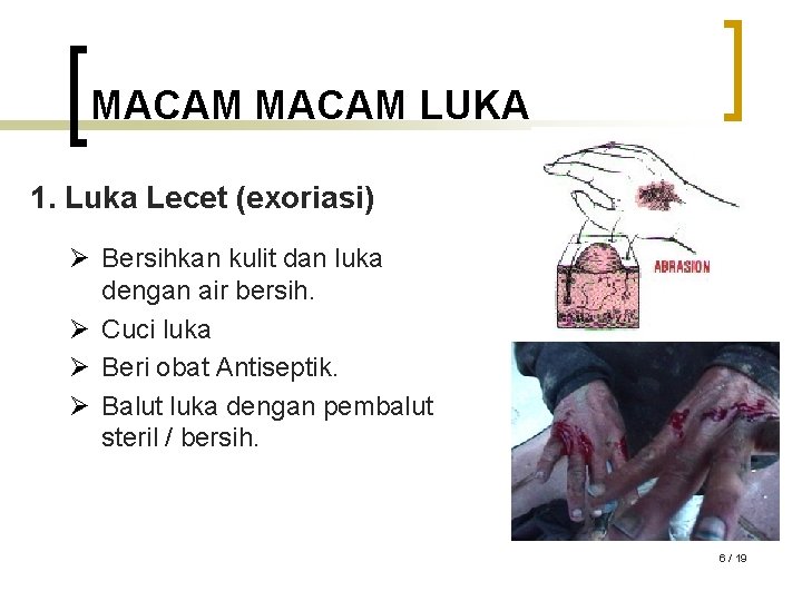 MACAM LUKA 1. Luka Lecet (exoriasi) Ø Bersihkan kulit dan luka dengan air bersih.