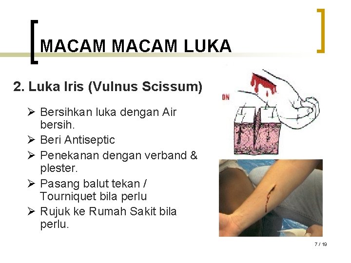 MACAM LUKA 2. Luka Iris (Vulnus Scissum) Ø Bersihkan luka dengan Air bersih. Ø