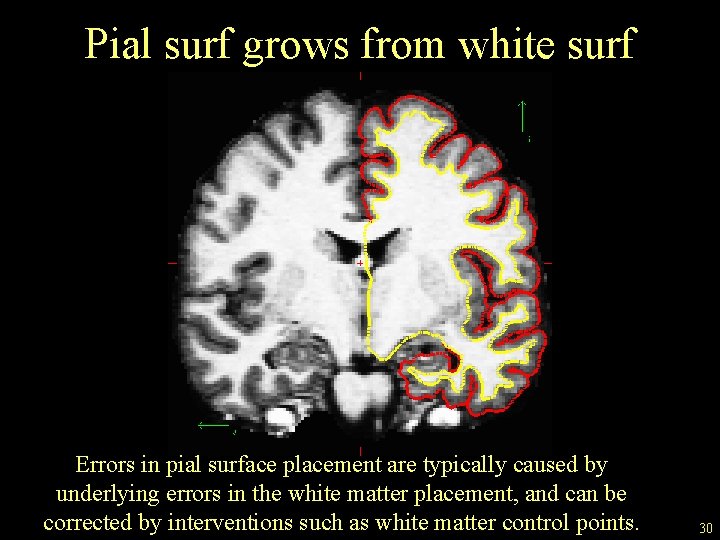Pial surf grows from white surf Errors in pial surface placement are typically caused