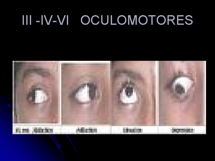 III -IV-VI OCULOMOTORES 