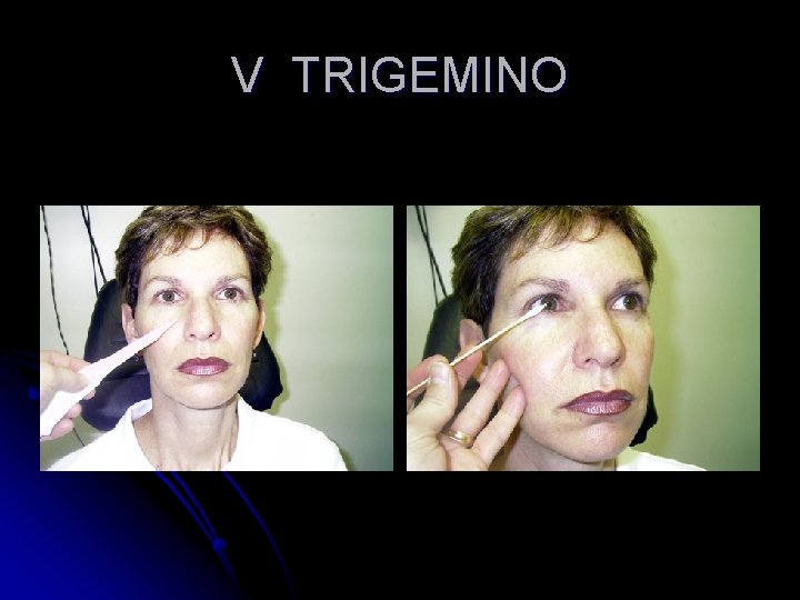 V TRIGEMINO 