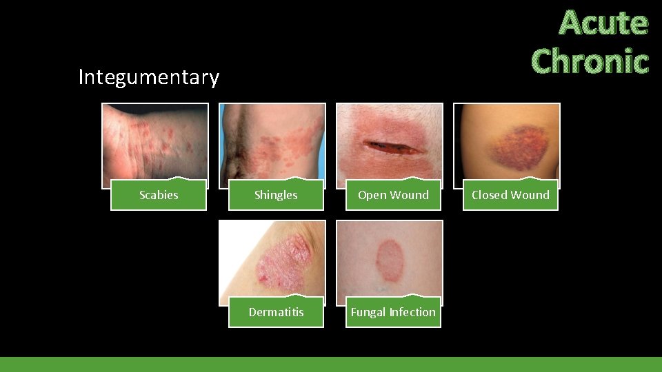 Acute Chronic Integumentary Scabies Shingles Open Wound Dermatitis Fungal Infection Closed Wound 