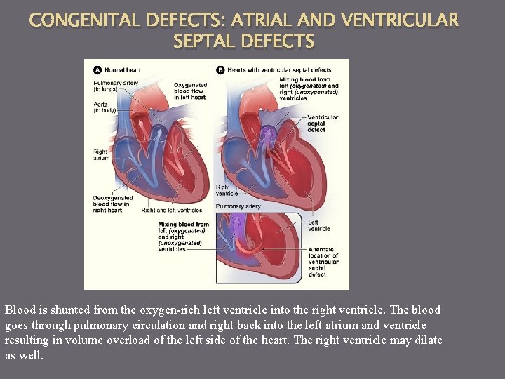 CONGENITAL DEFECTS: ATRIAL AND VENTRICULAR SEPTAL DEFECTS Blood is shunted from the oxygen-rich left