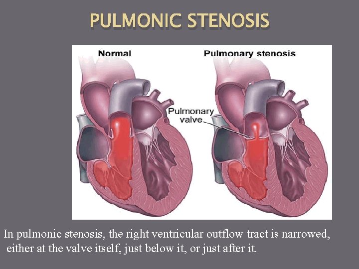 PULMONIC STENOSIS In pulmonic stenosis, the right ventricular outflow tract is narrowed, either at