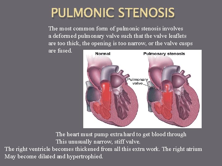 PULMONIC STENOSIS The most common form of pulmonic stenosis involves a deformed pulmonary valve