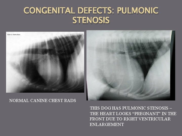 CONGENITAL DEFECTS: PULMONIC STENOSIS NORMAL CANINE CHEST RADS THIS DOG HAS PULMONIC STENOSIS –