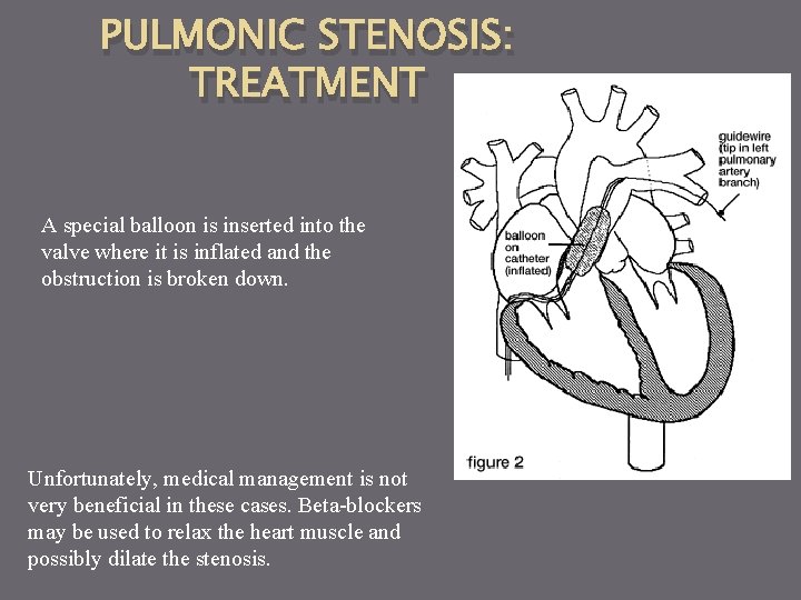 PULMONIC STENOSIS: TREATMENT A special balloon is inserted into the valve where it is