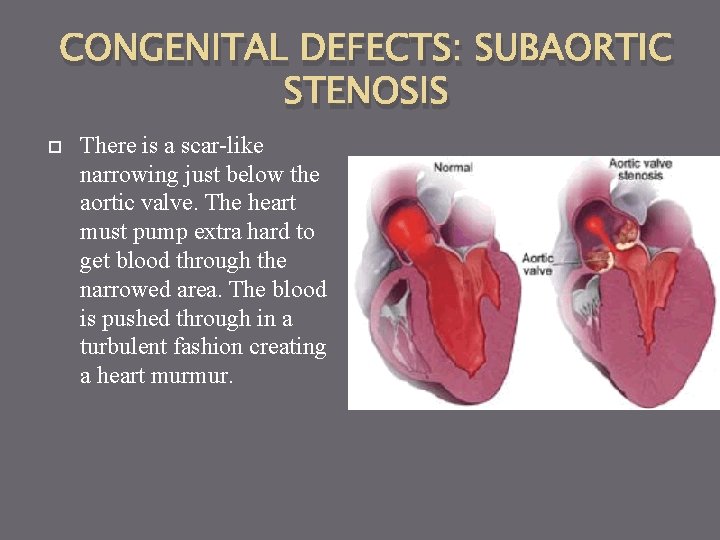 CONGENITAL DEFECTS: SUBAORTIC STENOSIS There is a scar-like narrowing just below the aortic valve.