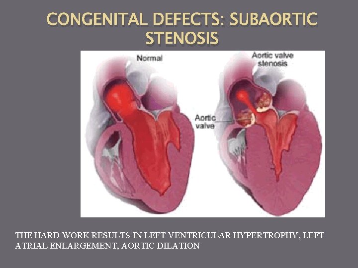 CONGENITAL DEFECTS: SUBAORTIC STENOSIS THE HARD WORK RESULTS IN LEFT VENTRICULAR HYPERTROPHY, LEFT ATRIAL