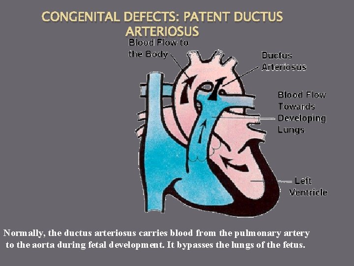CONGENITAL DEFECTS: PATENT DUCTUS ARTERIOSUS Normally, the ductus arteriosus carries blood from the pulmonary