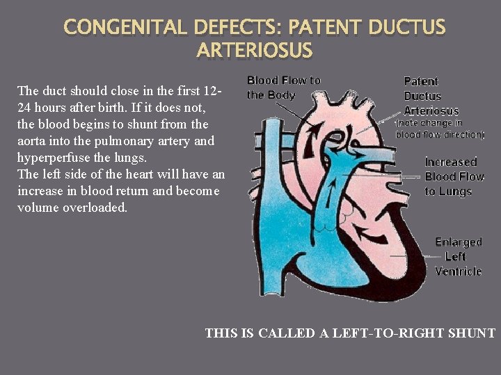 CONGENITAL DEFECTS: PATENT DUCTUS ARTERIOSUS The duct should close in the first 1224 hours