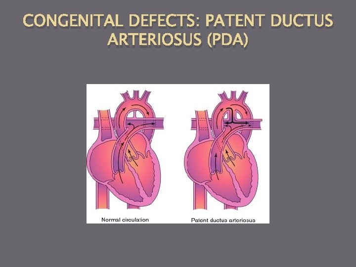 CONGENITAL DEFECTS: PATENT DUCTUS ARTERIOSUS (PDA) 