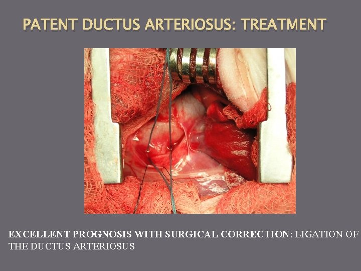 PATENT DUCTUS ARTERIOSUS: TREATMENT EXCELLENT PROGNOSIS WITH SURGICAL CORRECTION: LIGATION OF THE DUCTUS ARTERIOSUS