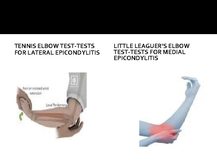 TENNIS ELBOW TEST-TESTS FOR LATERAL EPICONDYLITIS LITTLE LEAGUER’S ELBOW TEST-TESTS FOR MEDIAL EPICONDYLITIS 