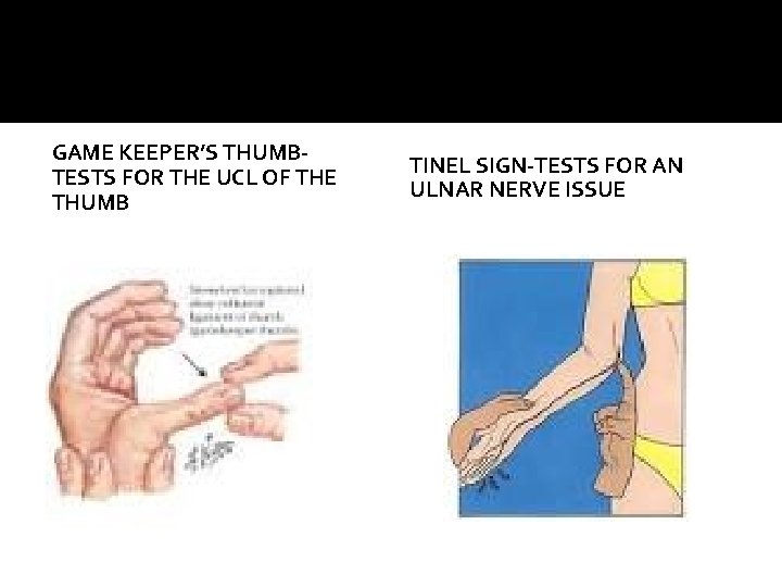 GAME KEEPER’S THUMBTESTS FOR THE UCL OF THE THUMB TINEL SIGN-TESTS FOR AN ULNAR