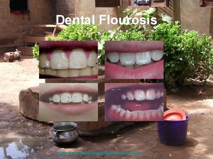 Dental Flourosis http: //www. solheim. bismarck. k 12. nd. us/images/mali snap gallery/mini- QWell. jpg