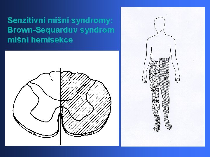 Senzitivní míšní syndromy: Brown-Sequardův syndrom míšní hemisekce 