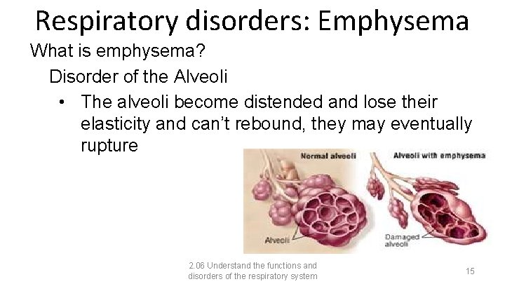 Respiratory disorders: Emphysema What is emphysema? Disorder of the Alveoli • The alveoli become