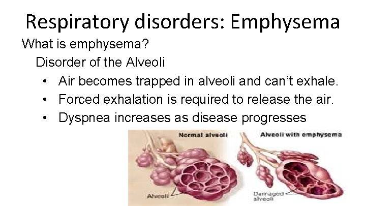 Respiratory disorders: Emphysema What is emphysema? Disorder of the Alveoli • Air becomes trapped