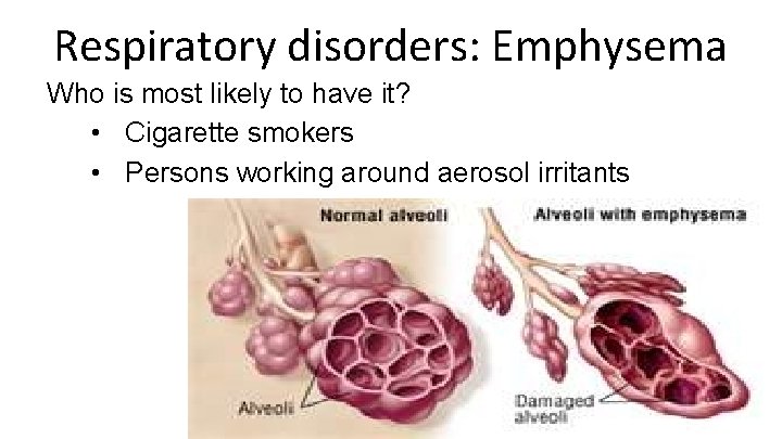 Respiratory disorders: Emphysema Who is most likely to have it? • Cigarette smokers •