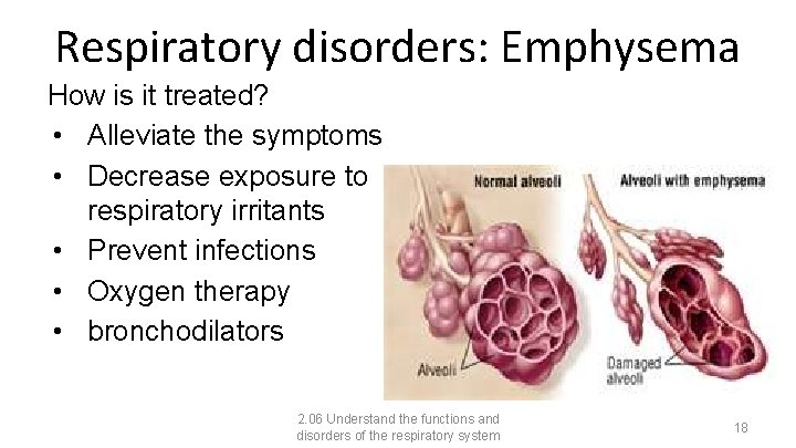 Respiratory disorders: Emphysema How is it treated? • Alleviate the symptoms • Decrease exposure